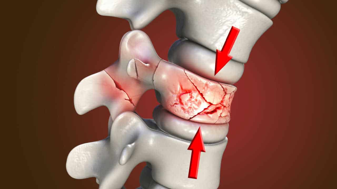 Ilustração de fratura na coluna vertebral em decorrência da osteoporose anvisa