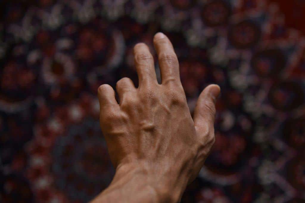 Parkinson