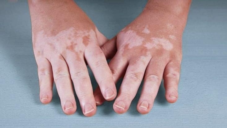 vitiligo